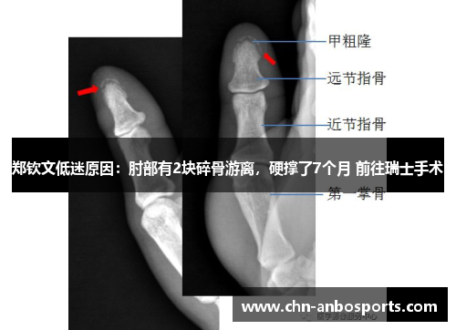郑钦文低迷原因:肘部有2块碎骨游离,硬撑了7个月 前往瑞士手术